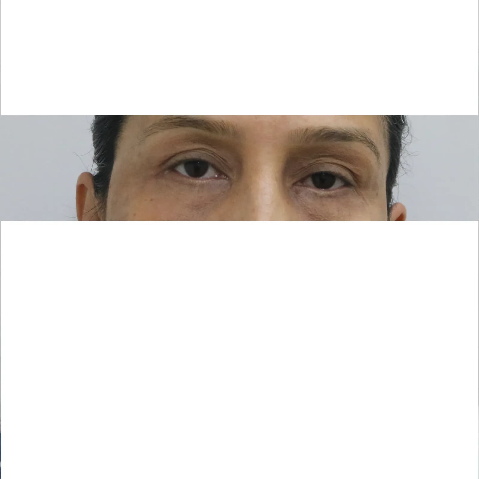After Blepharoplasty