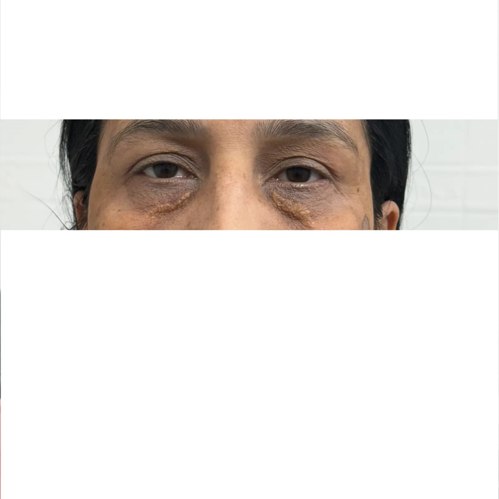 Before Blepharoplasty