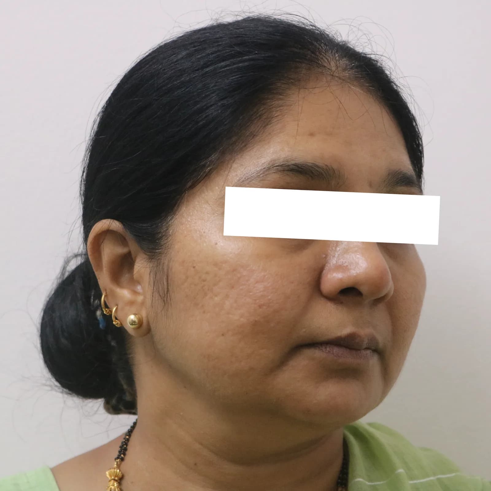 After MNRF Treatment