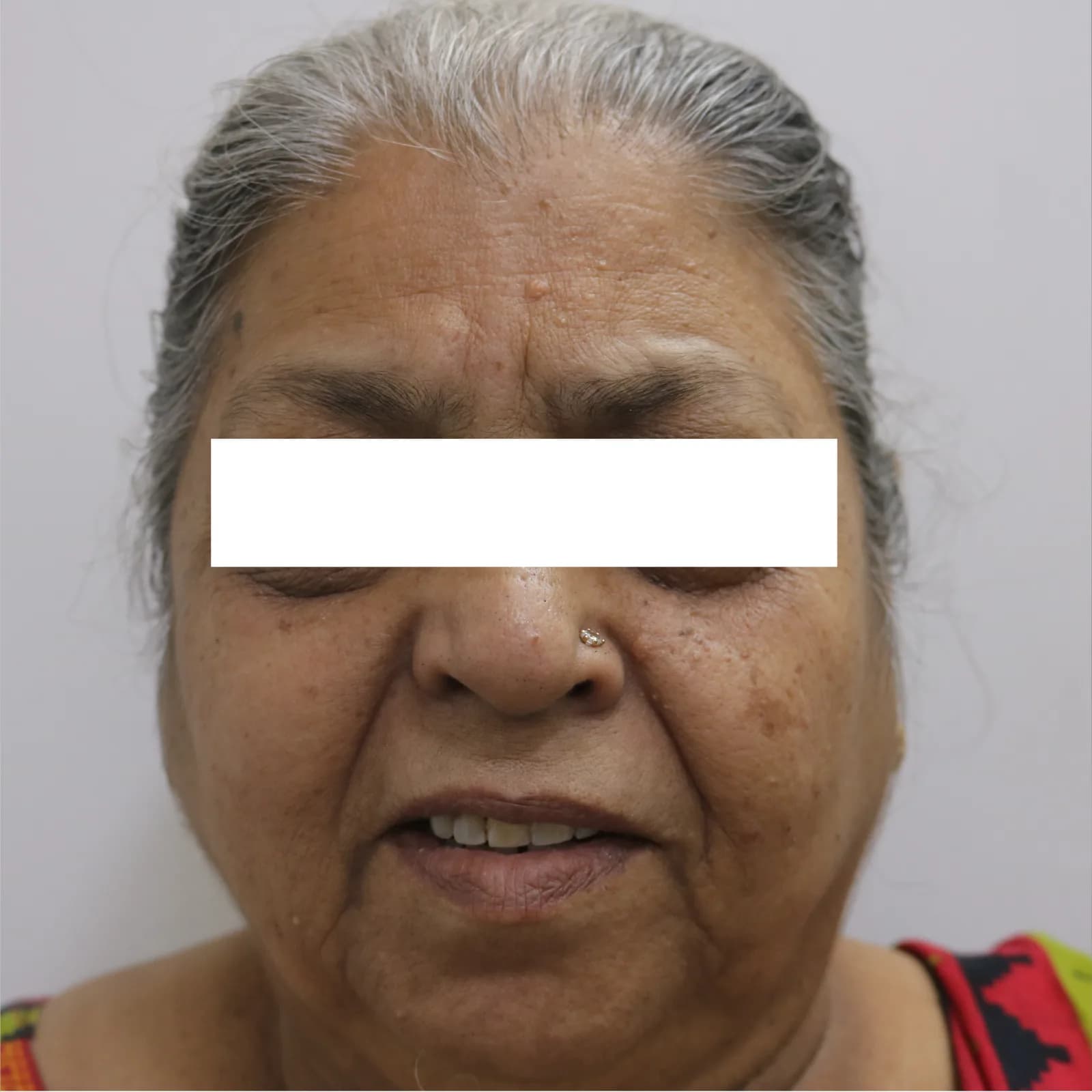 After Radiofrequency Treatment