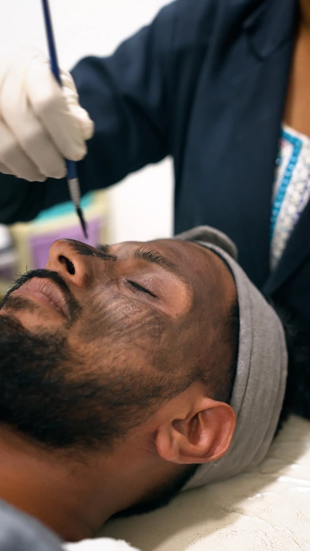Carbon / Charcoal Laser Peel