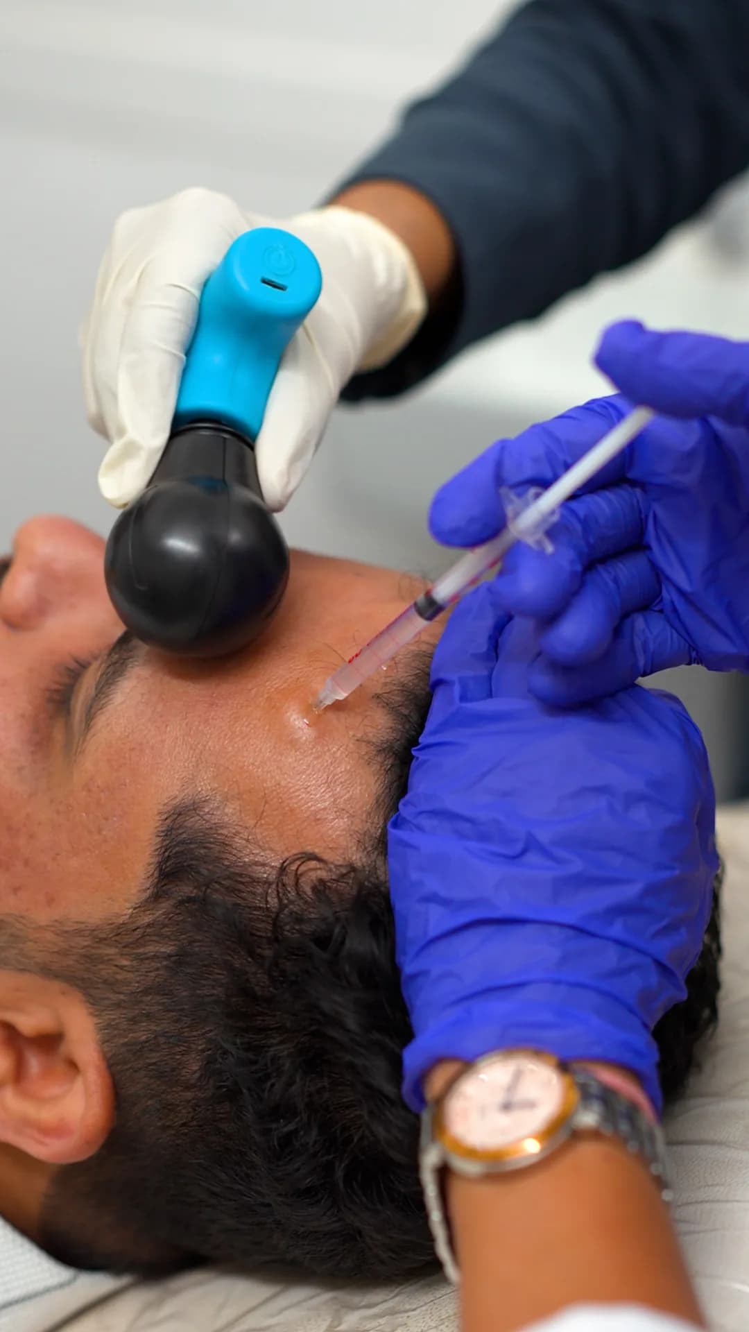 Mesotherapy for Hair